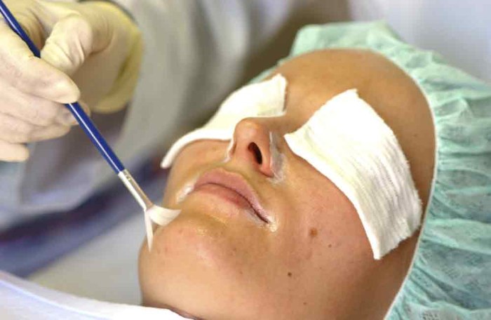 ¿Qué es un peeling facial químico?