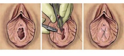 Hymenoplasty - hvad er det, før og efter fotos, operationens faser, resultater, rehabilitering og mulige komplikationer