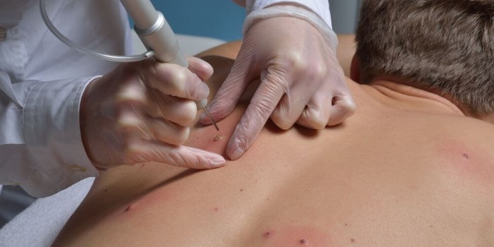 Hoe zich te ontdoen van papilloma, laserverwijdering op de nek, lichaam, gezicht, intieme plaatsen. Thuisbehandeling