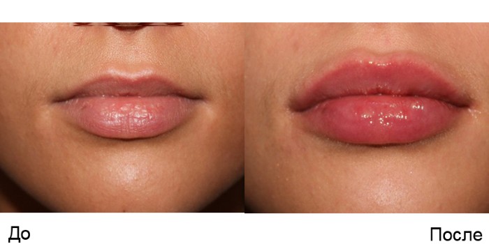 Konturowanie ust - technika powiększania ust kwasem hialuronowym, wypełniacze. Zdjęcia i ceny