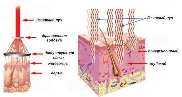 Tái tạo bề mặt da bằng laser cho các vết sẹo và sẹo. Hình ảnh trước và sau, giá cả, đánh giá. Chăm sóc da tại nhà sau liệu trình