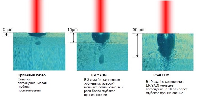 Lasersko presvlačenje kože za ožiljke i ožiljke. Fotografije prije i poslije, cijena, recenzije. Njega kože kod kuće nakon postupka
