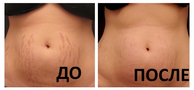 Laseroverflating av ansiktshud fra arr og arr. Bilder før og etter, pris, anmeldelser. Hjem hudpleie etter prosedyren