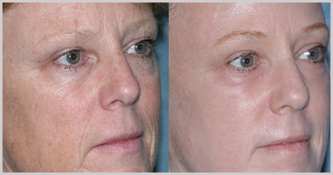 Laserový resurfacing kůže obličeje z jizev a jizev. Fotky před a po, cena, recenze. Domácí péče o pleť po proceduře