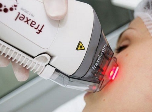 Laser-Hauterneuerung für Narben und Narben. Fotos vorher und nachher, Preis, Bewertungen. Hautpflege zu Hause nach dem Eingriff