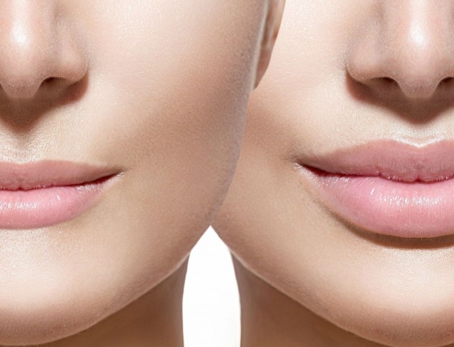 Powiększanie ust kwasem hialuronowym. Zdjęcia przed i po zabiegu, recenzje. Ile kosztują zastrzyki