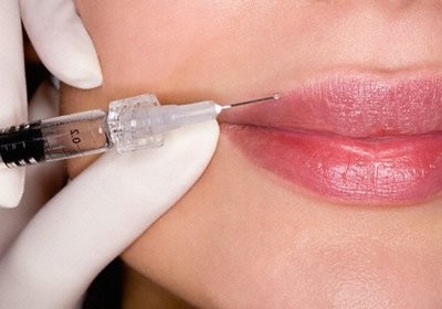 Augmentation des lèvres avec de l'acide hyaluronique. Photos avant et après la procédure, critiques.Combien coûtent les injections