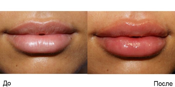 Povećanje usana hijaluronskom kiselinom. Fotografije prije i poslije postupka, pregledi. Koliko koštaju injekcije