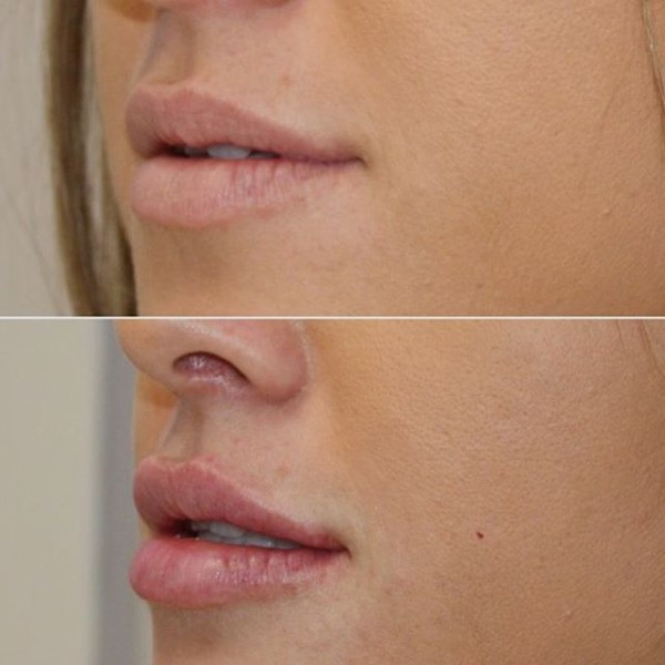 Powiększanie ust kwasem hialuronowym. Zdjęcia przed i po zabiegu, recenzje. Ile kosztują zastrzyki