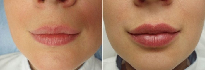 Pembesaran bibir dengan asid hyaluronik. Foto sebelum dan selepas prosedur, ulasan. Berapa kos suntikan