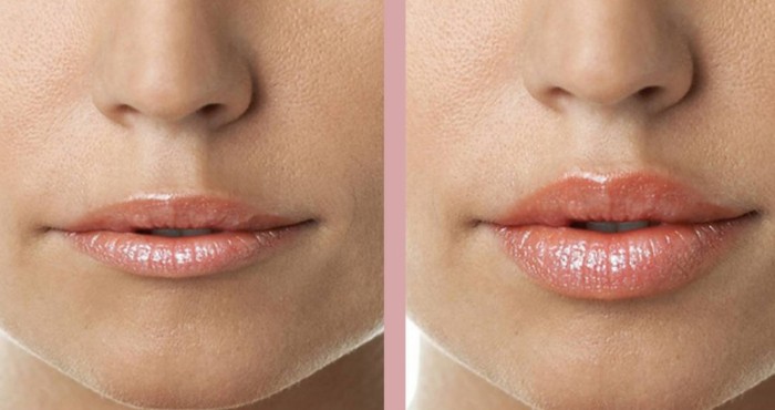 Pembesaran bibir dengan asid hyaluronik. Foto sebelum dan selepas prosedur, ulasan. Berapa kos suntikan