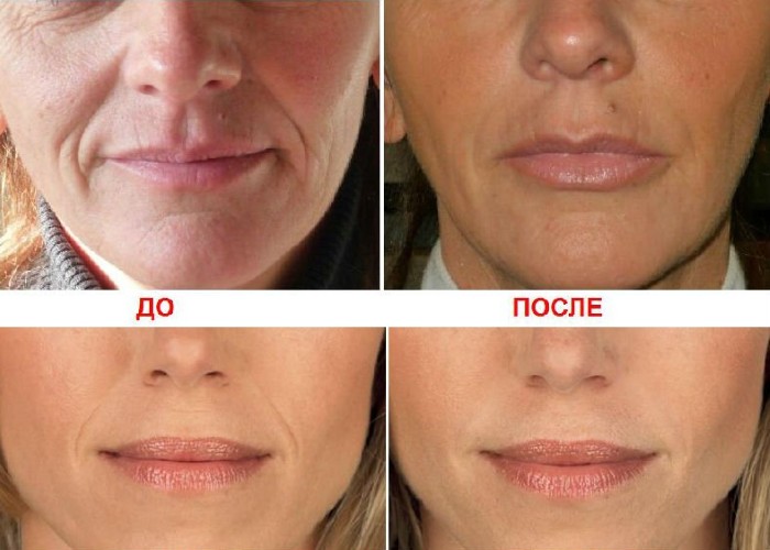 Lip augmentation with hyaluronic acid. Photos before and after the procedure, reviews. How much do injections cost