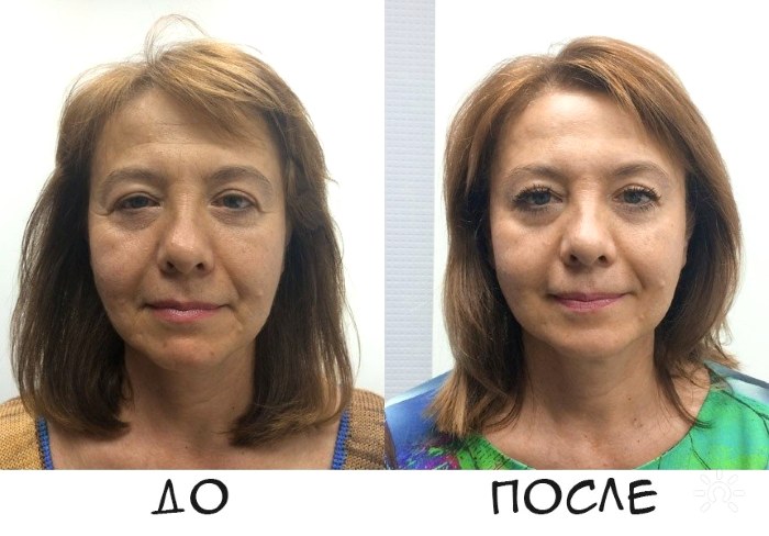 Gvaš masaža - što je to, tehnika izvođenja, kako se radi za lice, leđa, fotografije prije i poslije