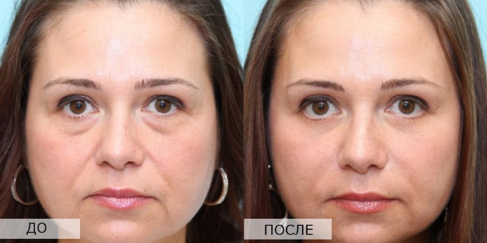 Dòng điện vi mô cho khuôn mặt trong thẩm mỹ - một quy trình trị liệu bằng máy. Giá cả, đánh giá