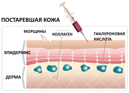 Teràpia plasmàtica: plasmolifting de la pell de la cara i el coll, indicacions, contraindicacions, fotos, preu del procediment, comentaris