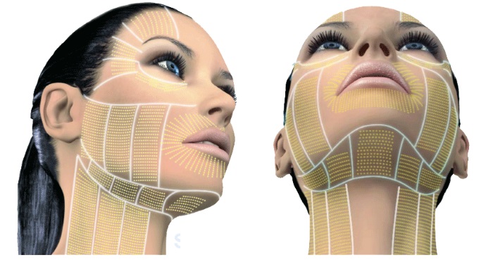 Plazmová terapie - plazmolifting kůže na obličeji a krku, indikace, kontraindikace, fotografie, cena postupu, recenze