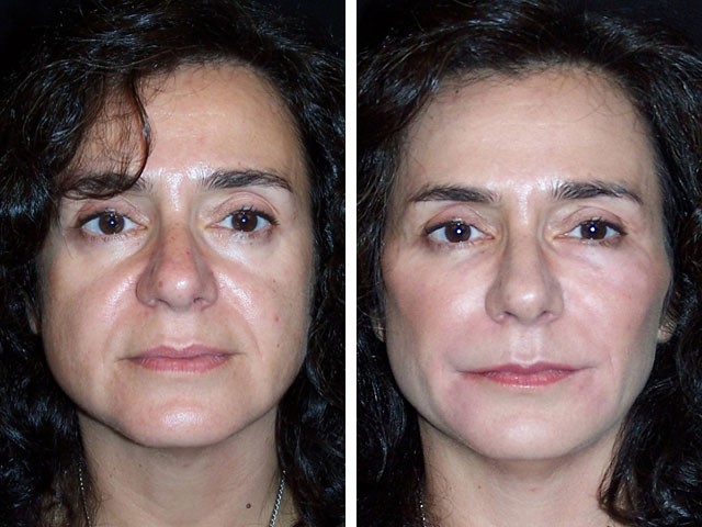 Radiesse - preparat wypełniający do liftingu wektorowego w kosmetologii