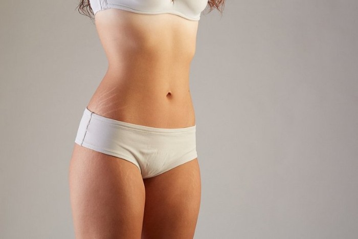 علامات التمدد عند النساء الحوامل والمراهقات على الجسم والبطن والصدر والساقين والأرداف والظهر. أسباب كيفية الإزالة