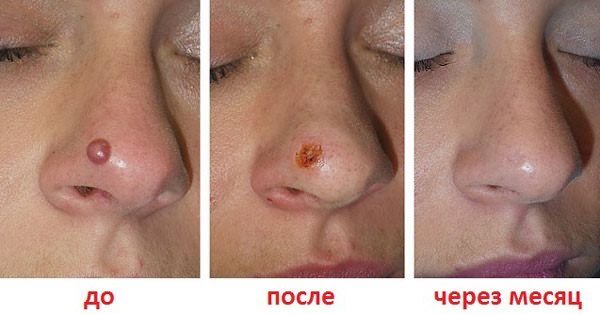 Laser removal of moles, surgical method, at home. Consequences, how long the wound heals, scars