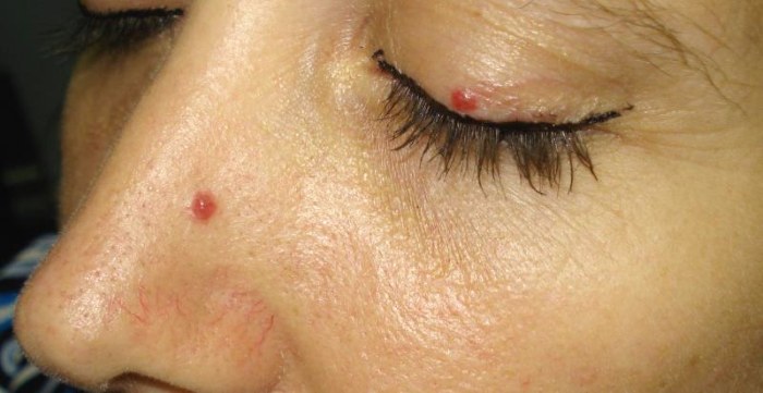 Laser removal of moles, surgical method, at home. Consequences, how long the wound heals, scars