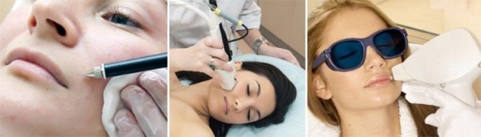 Comment se débarrasser des poils du visage chez les femmes - produits et procédures, enlever avec du fil, de la crème, du laser