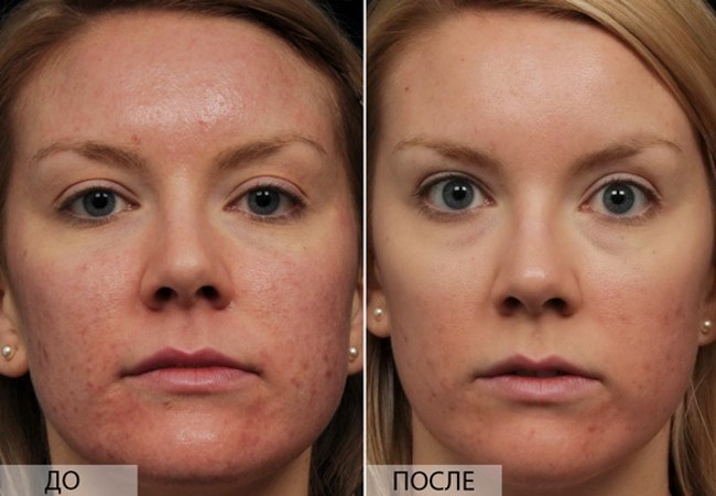 Trẻ hóa phân vùng - nó là gì, ưu và nhược điểm của da mặt, đánh giá