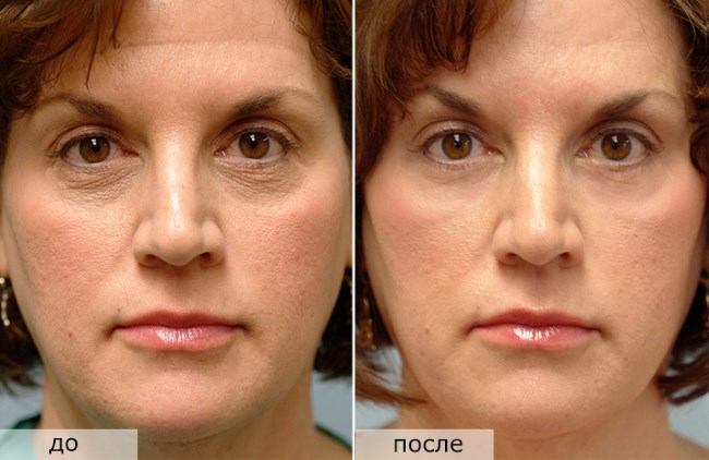 Fractional Verjüngung - was ist es, die Vor- und Nachteile für die Gesichtshaut, Bewertungen