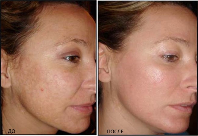 Rejuvenecimiento fraccional: que es, pros y contras de la piel del rostro, reseñas