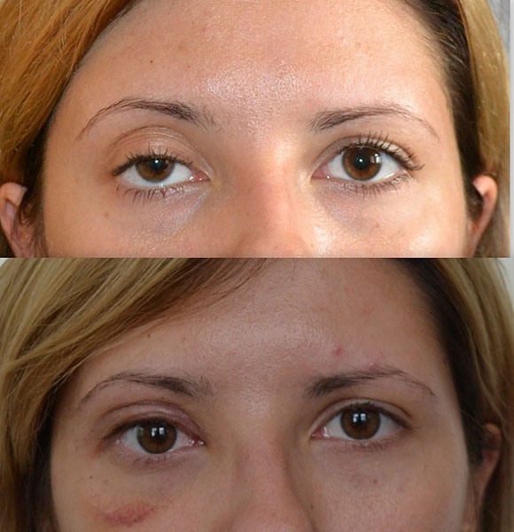 What is botox for the face, injections, injections of nano botox in the forehead, nasolabial folds, armpits