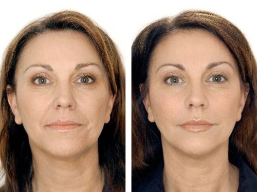 Was ist Botox für das Gesicht, Injektionen, Injektionen von Nano-Botox in die Stirn, Nasolabialfalten, Achselhöhlen