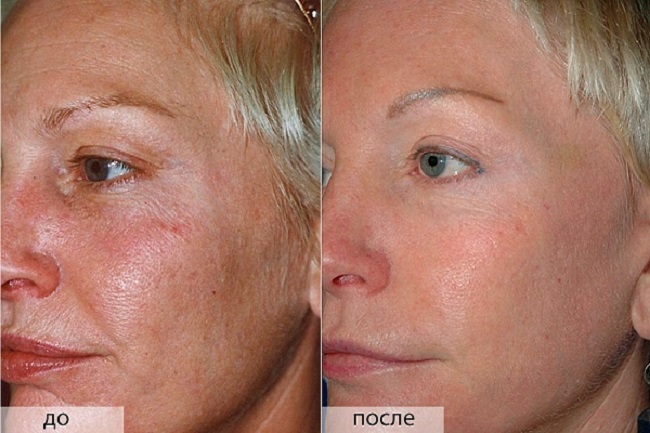 Esfoliação de amêndoa para o rosto - o que é, como se faz, antes e depois das fotos, avaliações