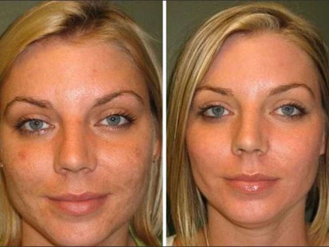 Бадемов пилинг за лице - шта је то, како се то ради, пре и после фотографија, рецензија