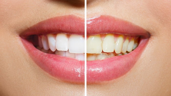 Hoe tanden thuis witter te maken zonder het glazuur snel te beschadigen door geelheid. Producten en volksrecepten