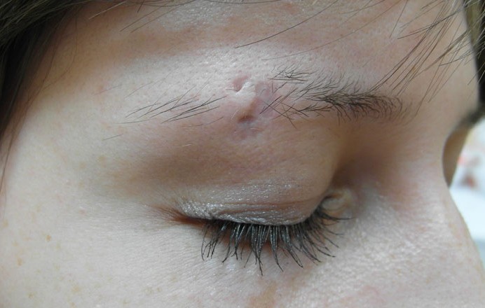 Cicatrices chéloïdes après la chirurgie - qu'est-ce que c'est et pourquoi sont-elles dangereuses? À quoi ressemblent les cicatrices chéloïdes. Une photo