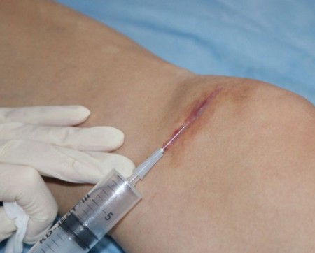 Sẹo lồi sau phẫu thuật - nó là gì và tại sao chúng nguy hiểm? Những vết sẹo lồi trông như thế nào. Một bức ảnh