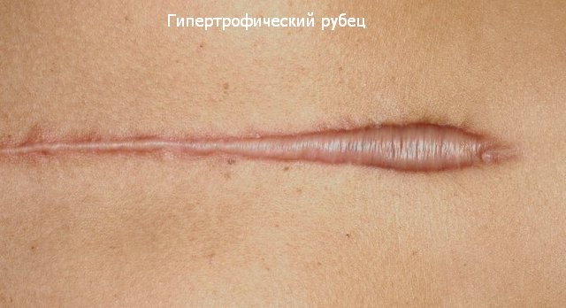 Cicatrius queloides després de la cirurgia: què és i per què són perillosos? Com són les cicatrius queloides. Una foto