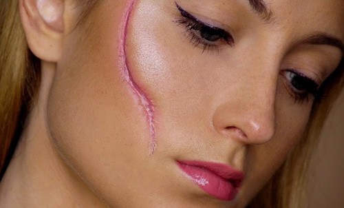 Cicatrices chéloïdes après la chirurgie - qu'est-ce que c'est et pourquoi sont-elles dangereuses? À quoi ressemblent les cicatrices chéloïdes. Une photo