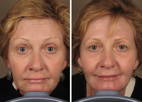 Facelift - chỉnh sửa hình dạng khuôn mặt mà không cần phẫu thuật, trong thẩm mỹ viện. Ảnh trước và sau