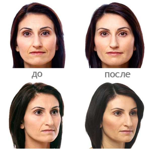 Yüz için hyaluronik asit: enjeksiyonların nasıl yapıldığı, sonuçlar, enjeksiyon öncesi ve sonrası fotoğraflar, incelemeler