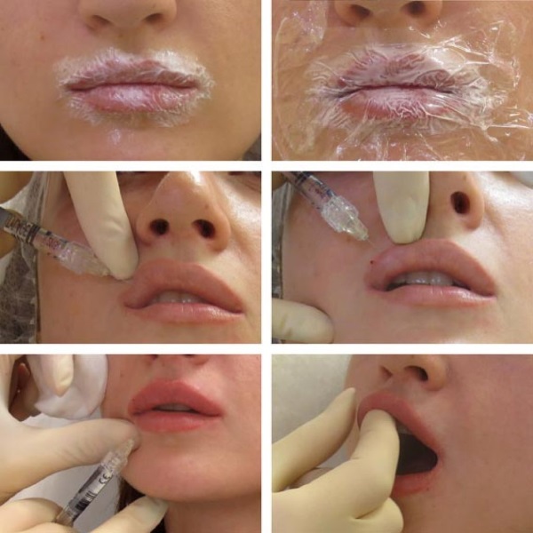 Yüz için hyaluronik asit: enjeksiyonların nasıl yapıldığı, sonuçlar, enjeksiyon öncesi ve sonrası fotoğraflar, incelemeler
