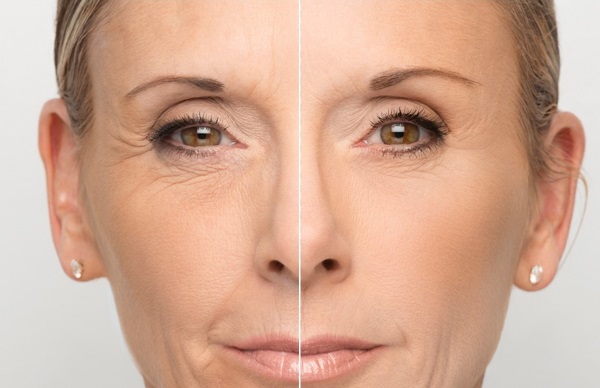 Ácido hialurónico para el rostro: cómo se realizan las inyecciones, resultados, fotos antes y después de las inyecciones, revisiones.