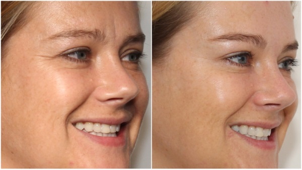 Hyaluronzuur voor het gezicht: hoe de injecties worden uitgevoerd, resultaten, foto's voor en na injecties, beoordelingen