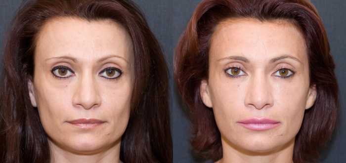 Kwas hialuronowy na twarz: jak wykonywane są zastrzyki, wyniki, zdjęcia przed i po zastrzykach, recenzje