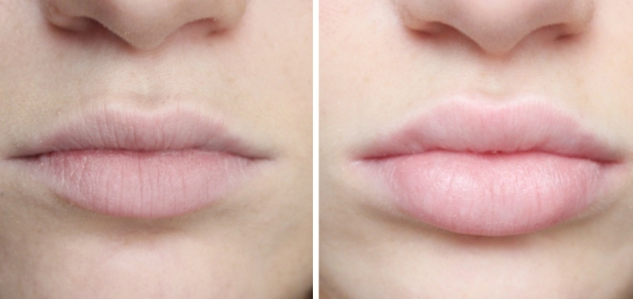 Hyaluronsyra på läpparna - före och efter foton, hur länge effekten varar, kontraindikationer