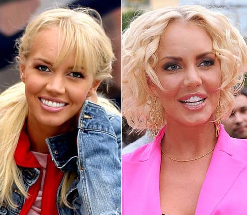 Fotos de estrelas antes e depois de cirurgia plástica, rinoplastia em celebridades