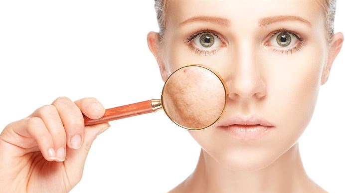 البقع المصطبغة على الوجه - كيفية التخلص منها في المنزل: العلاجات الشعبية ، والمراهم من الصيدلية ، والأدوية في التجميل
