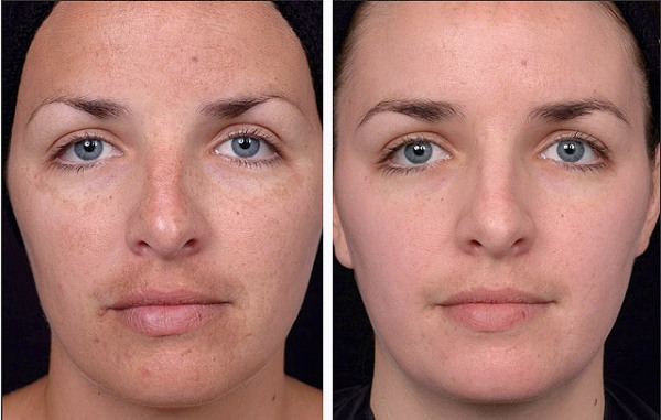 Gesicht Peeling zu Hause für Falten, Hautverjüngung. Rezepte, Gebrauchsanweisung, Fotos