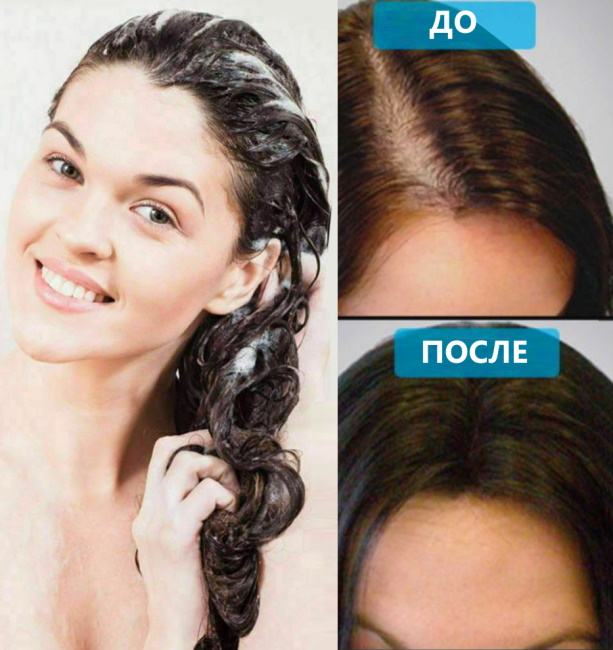 Shampooings médicaux pour la perte de cheveux en pharmacie. Top 10 des remèdes les plus efficaces