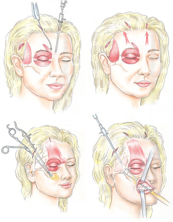 SMAS lifting: neteja ultrasònica de la cara. Característiques del procediment, indicacions, contraindicacions, efecte esperat, foto
