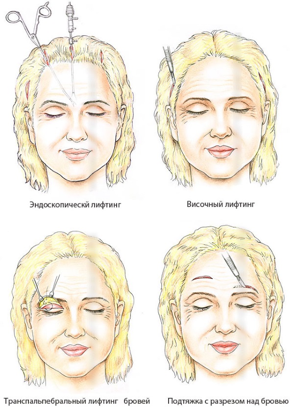 Levantamiento SMAS - limpieza facial ultrasónica. Características del procedimiento, indicaciones, contraindicaciones, efecto esperado, foto.